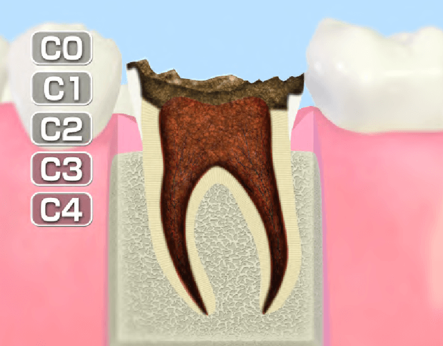 歯質が失われた歯(C4)