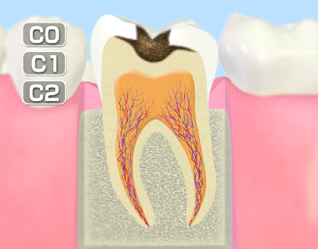 進行したむし歯(C2)