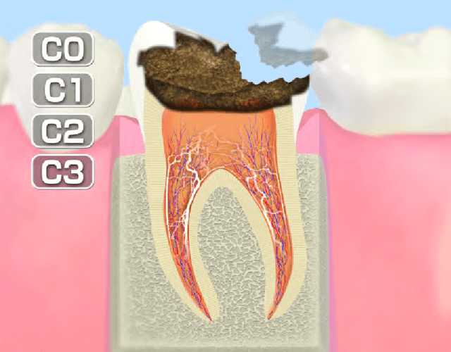 歯髄まで進行したむし歯 (C3)