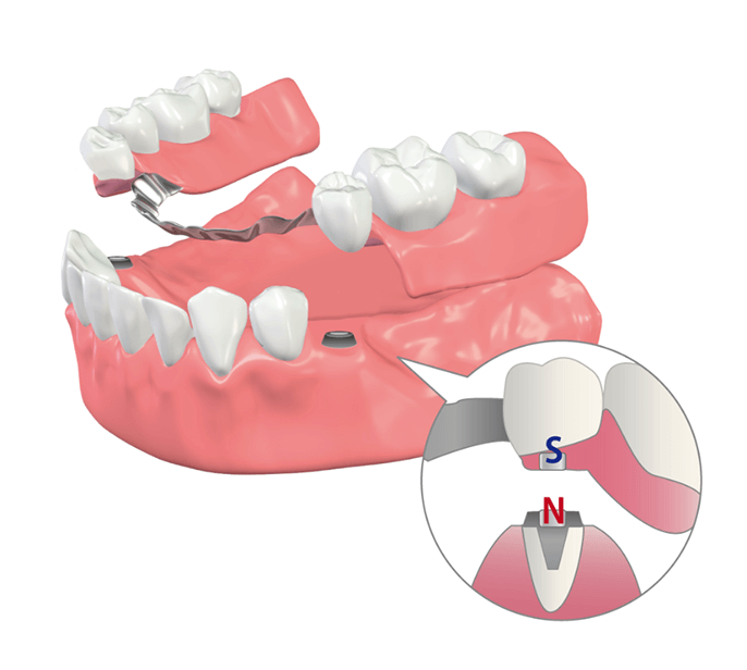 マグネット対応義歯