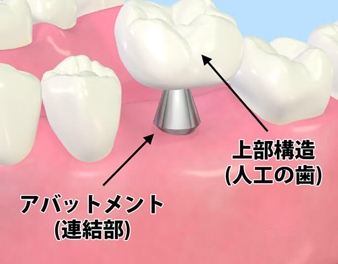 人工歯の装着