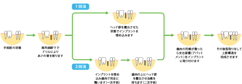 2回法による治療