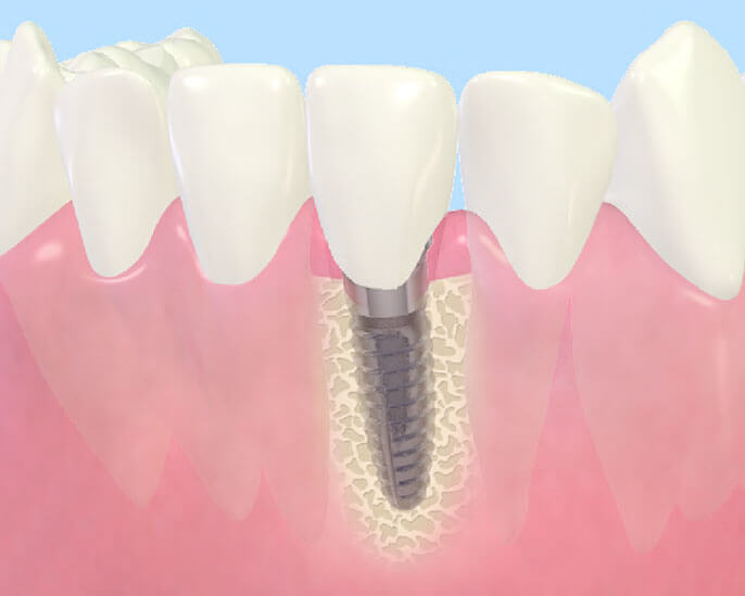 インプラント治療